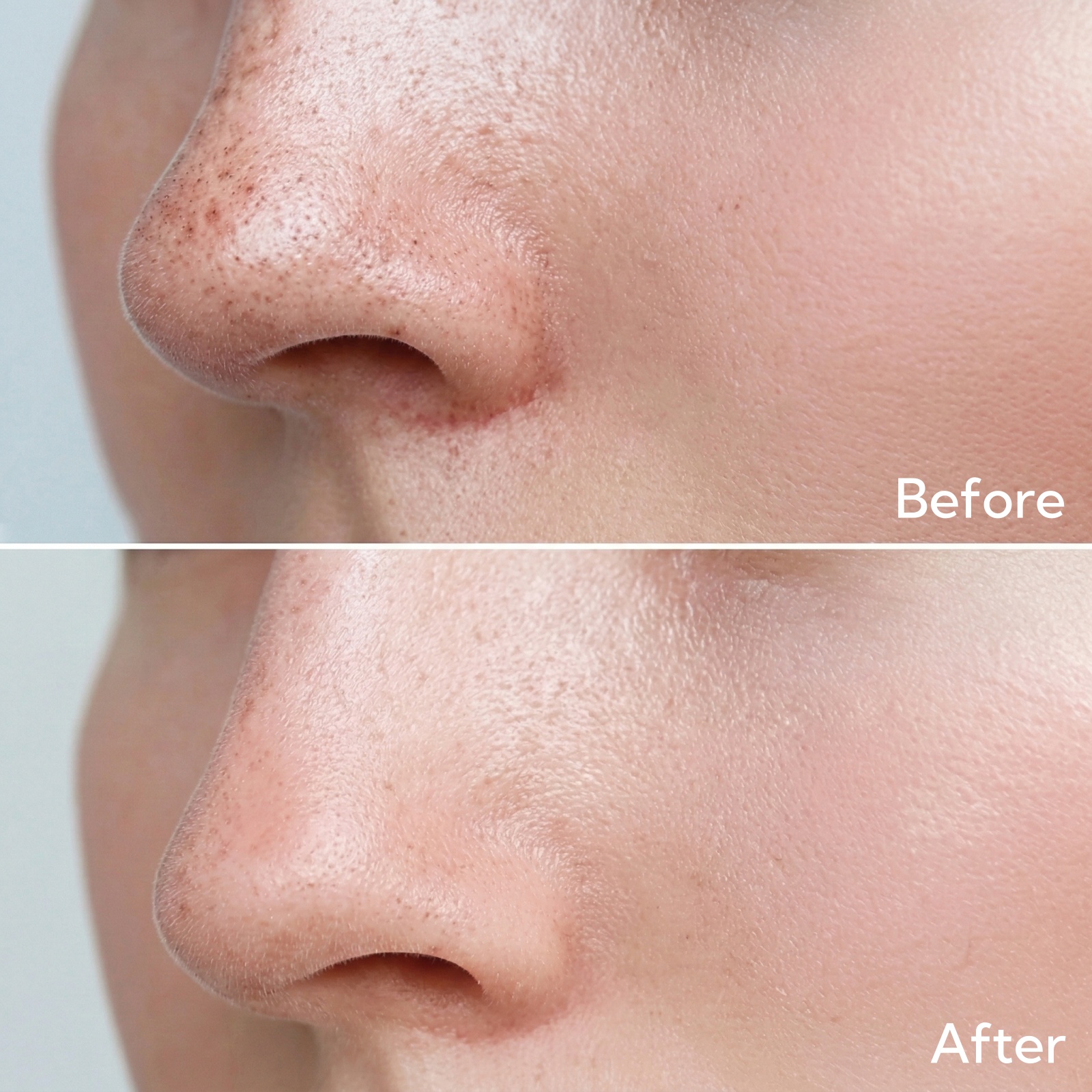 blackhead remover strip_feature 3